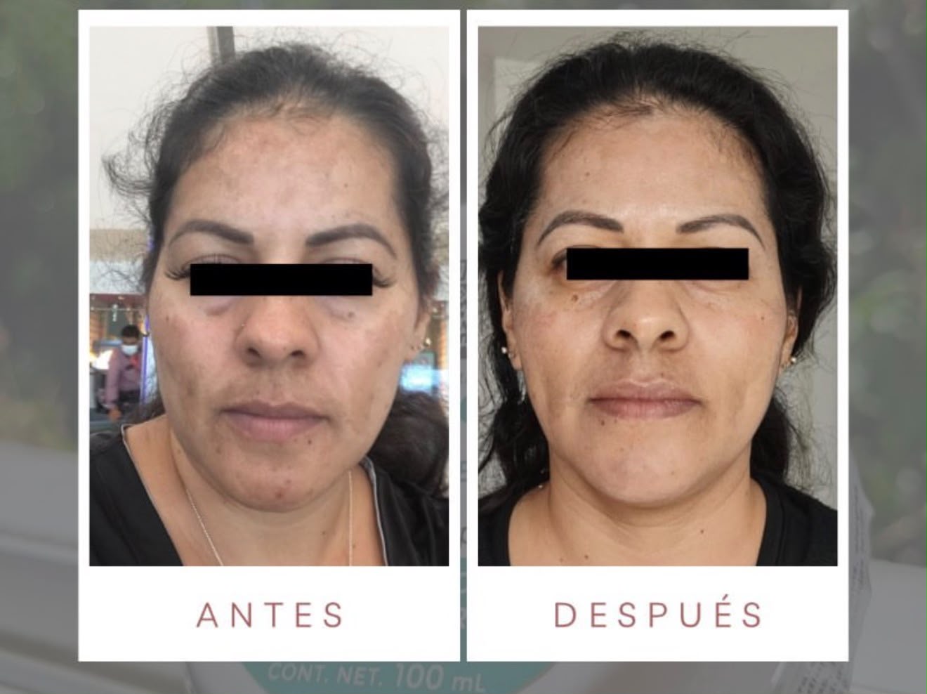 Antes y después con productos LUMINE