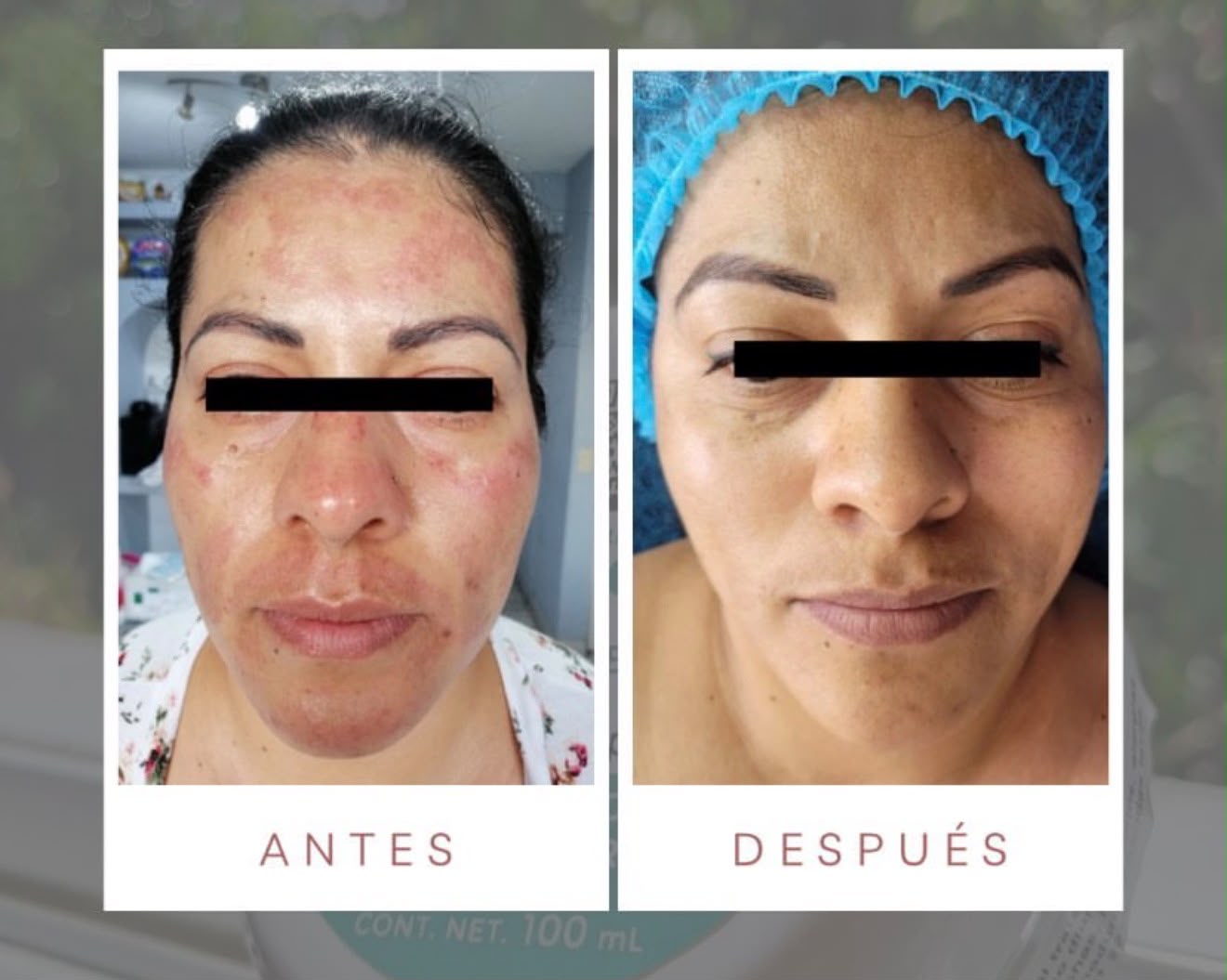 Antes y después con productos LUMINE