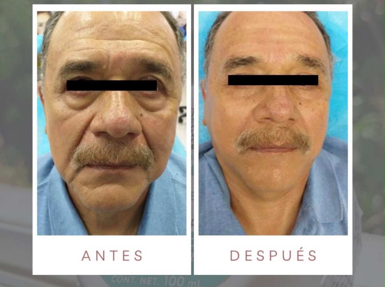 Antes y después con productos LUMINE