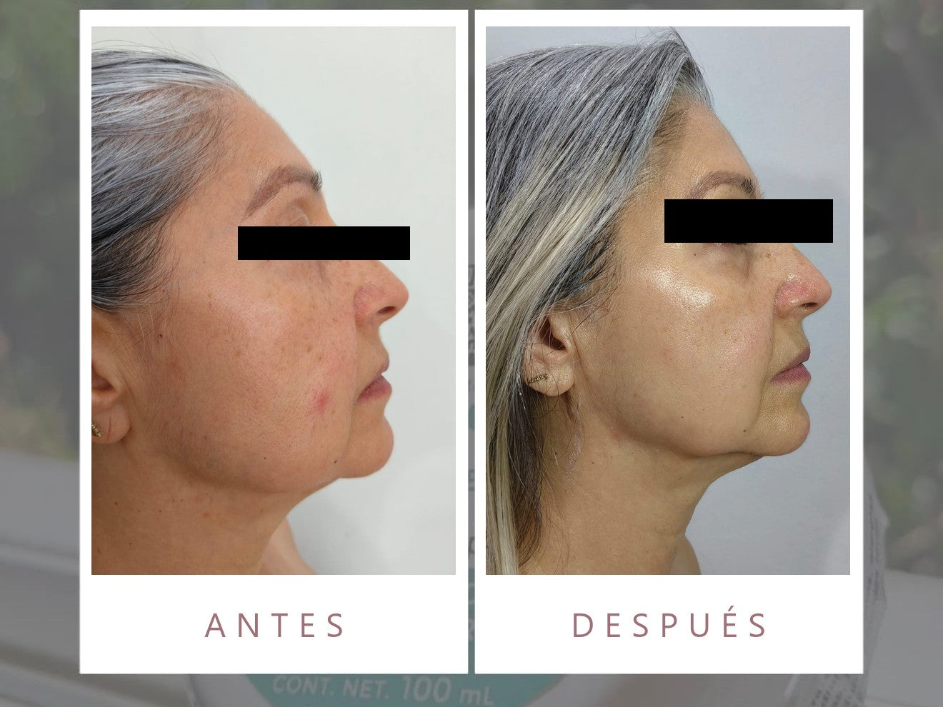 Antes y después con productos LUMINE